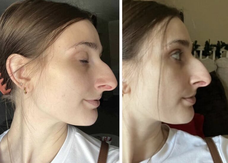 People Can’t Believe How This Woman Looks After Getting A $11k Nose Job